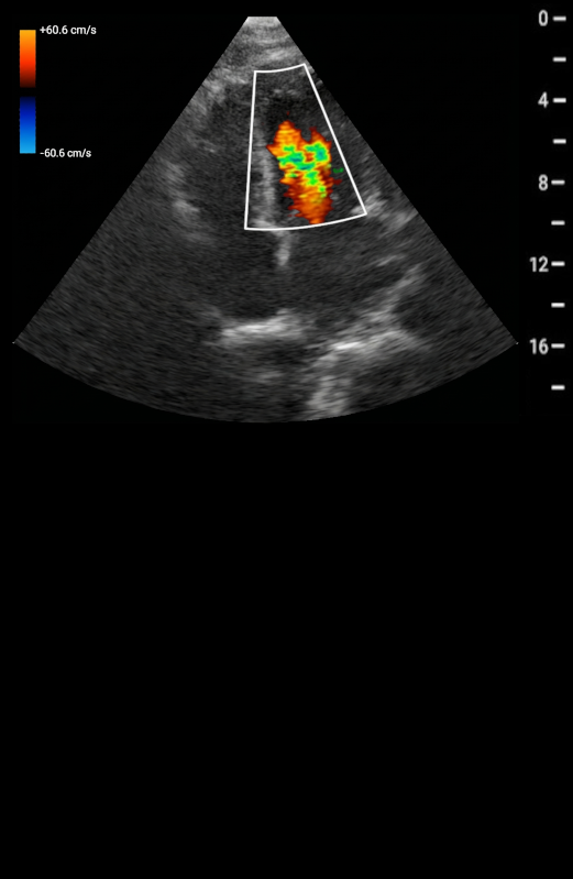 Color Doppler Flow