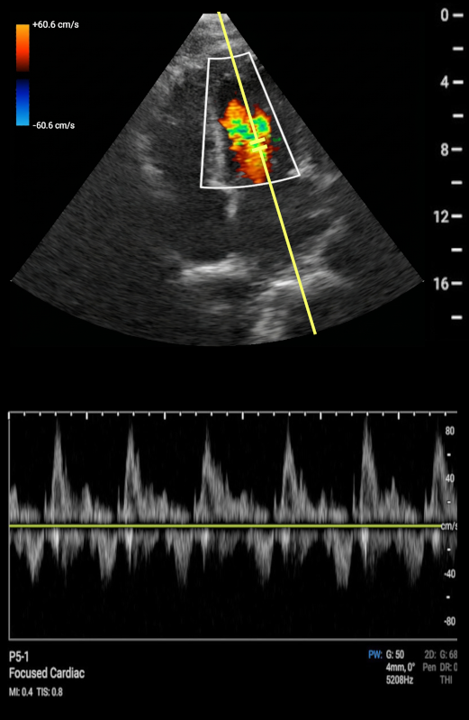 Spectral Doppler Tracing
