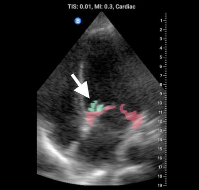 endocarditis w/ guides