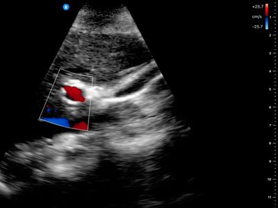 liver with colour doppler