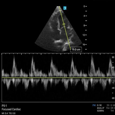 echo-pulsed wave