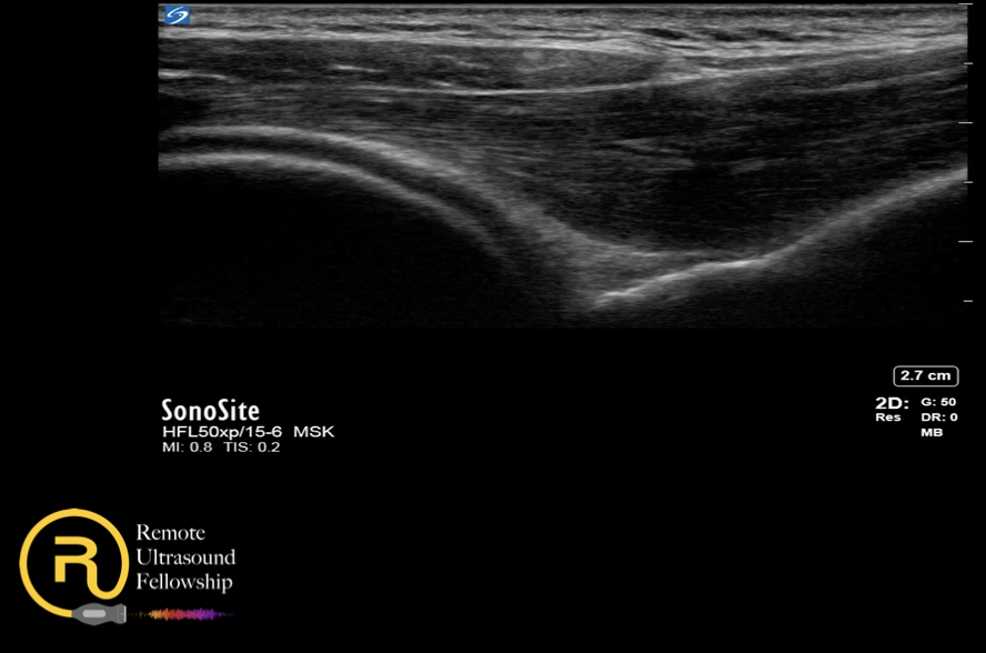 posterior shoulder dislocation
