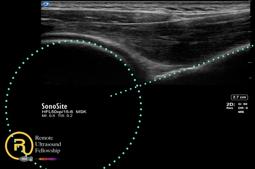 posterior shoulder dislocation w/ guides